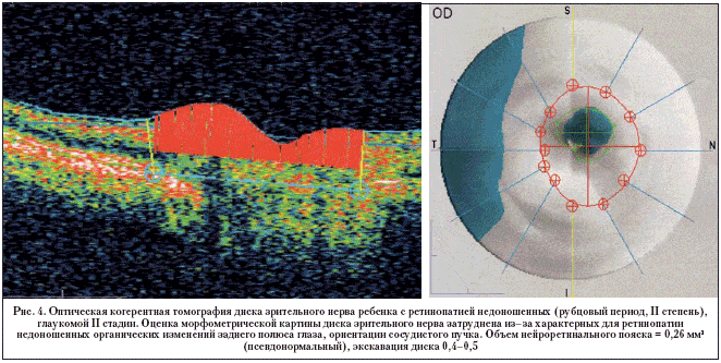 Рис. 4. Оптическая когерентная томография диска зрительного нерва ребенка с ретинопатией недоношенных (рубцовый период, II степень), глаукомой II стадии. Оценка морфометрической картины диска зрительного нерва затруднена из–за характерных для ретинопатии недоношенных органических изменений заднего полюса глаза, ориентации сосудистого пучка. Объем нейроретинального пояска = 0,26 мм3 (псевдонормальный), экскавация диска 0,4–0,5