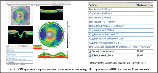 Рис. 1. СОКТ зрительного нерва и толщины слоя нервных волокон вокруг ДЗН правого глаза (RNFL) до лечения Ретиналамином