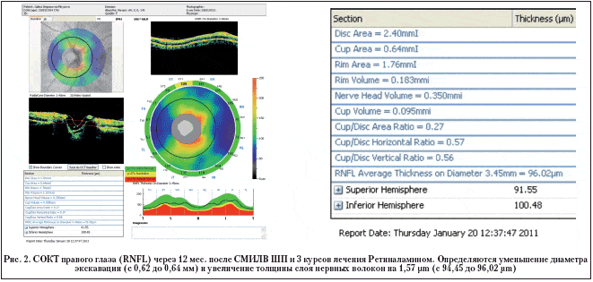Рис. 2. СОКТ правого глаза (RNFL) через 12 мес. после СМИЛВ ШП и 3 курсов лечения Ретиналамином. Определяются уменьшение диаметра экскавации (с 0,62 до 0,64 мм) и увеличение толщины слоя нервных волокон на 1,57 μm (с 94,45 до 96,02 μm)