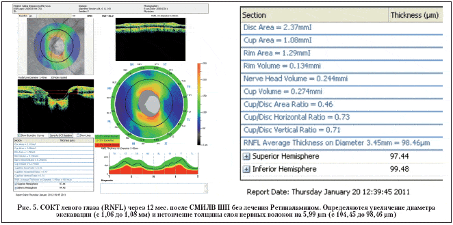 Рис. 5. СОКТ левого глаза (RNFL) через 12 мес. после СМИЛВ ШП без лечения Ретиналамином. Определяются увеличение диаметра экскавации (с 1,06 до 1,08 мм) и истончение толщины слоя нервных волокон на 5,99 μm (с 104,45 до 98,46 μm)