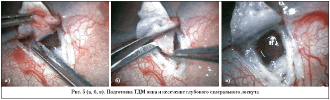 Рис. 5 (а, б, в). Подготовка TДM окна и иссечение глубокого склерального лоскута