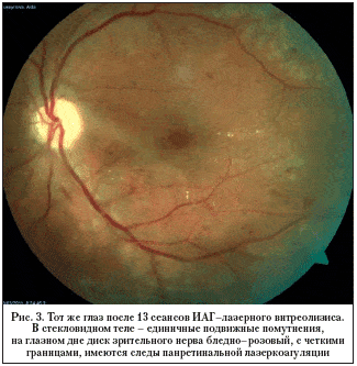 Рис. 3. Тот же глаз после 13 сеансов ИАГ–лазерного витреолизиса. В стекловидном теле – единичные подвижные помутнения, на глазном дне диск зрительного нерва бледно–розовый, с четкими границами, имеются следы панретинальной лазеркоагуляции