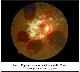 Рис. 1. Картина глазного дна больного Б., 37 лет. Диагноз: ретинопатия Пурчера