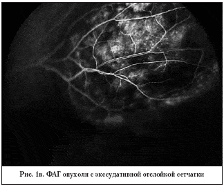 Рис. 1в. ФАГ опухоли с экссудативной отслойкой сетчатки