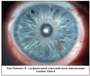 Глаз больного К. с рефрактерной глаукомой после имплантации клапана Ahmed