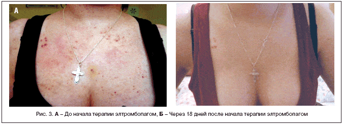 Рис. 3. А – До начала терапии элтромбопагом, Б – Через 18 дней после начала терапии элтромбопагом