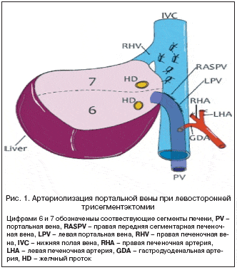 Рис. 1. Артериолизация портальной вены при левосторонней трисегментэктомии