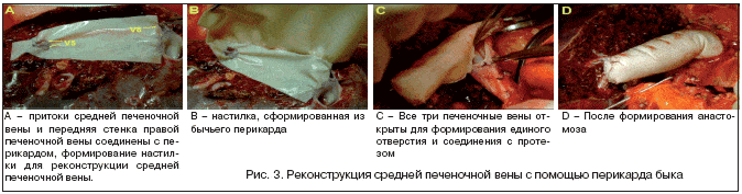 Рис. 3. Реконструкция средней печеночной вены с помощью перикарда быка