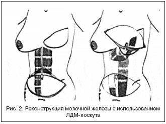 Рис. 2. Реконструкция молочной железы с использованием ЛДМ-лоскута