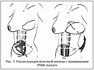Рис. 3. Реконструкция молочной железы с применением ТРАМ-лоскута