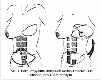 Рис. 4. Реконструкция молочной железы с помощью свободного ТРАМ-лоскута