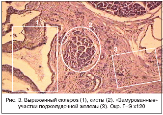 Рис. 3. Выраженный склероз (1), кисты (2). «Замурованные» участки поджелудочной железы (3). Окр. Г–Э х120