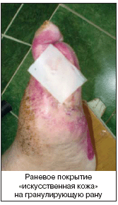 Раневое покрытие «искусственная кожа» на гранулирующую рану