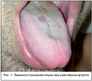 Рис. 1. Язвенное поражение языка при реактивном артрите