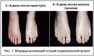Диагностика подагрического артрита | Барскова В.Г. | «РМЖ» №10 от ...
