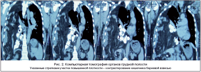 Рис. 2. Компьютерная томография органов грудной полости