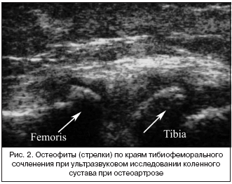 Рис. 2. Остеофиты (стрелки) по краям тибиофеморального сочленения при ультразвуковом исследовании коленного сустава при остеоартрозе