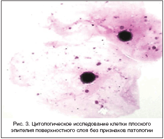 Рис. 3. Цитологическое исследование клетки плоского эпителия поверхностного слоя без признаков патологии