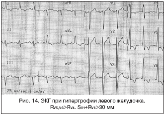 Рис. 14. ЭКГ при гипертрофии левого желудочка. RV5, V6>RV4. SV1+RV6>30 мм