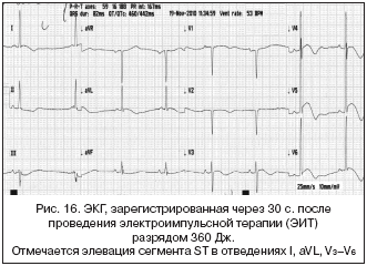 Рис. 16. ЭКГ, зарегистрированная через 30 с. после проведения электроимпульсной терапии (ЭИТ) разрядом 360 Дж. Отмечается элевация сегмента ST в отведениях I, aVL, V3–V6