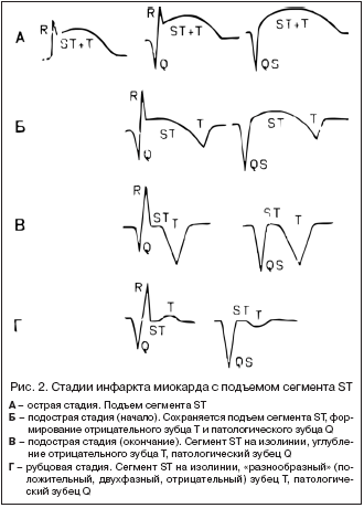 Рис. 2. Стадии инфаркта миокарда с подъемом сегмента ST