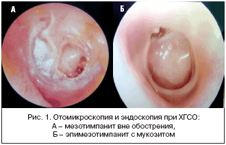 Рис. 1. Отомикроскопия и эндоскопия при ХГСО
