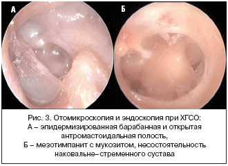 Рис. 3. Отомикроскопия и эндоскопия при ХГСО