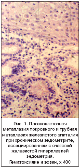 Рис. 1. Плоскоклеточная метаплазия покровного и трубная метаплазия железистого эпителия при хроническом эндометрите, ассоциированном с очаговой железистой гиперплазией эндометрия. Гематоксилин и эозин, x 400