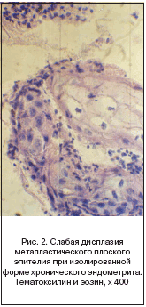 Рис. 2. Слабая дисплазия метапластического плоского эпителия при изолированной форме хронического эндометрита. Гематоксилин и эозин, x 400