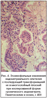 Рис. 4. Эозинофильные изменения эндометриального эпителия с последующей трансформацией их в многослойный плоский при изолированной форме хронического эндометрита. Гематоксилин и эозин, x 400