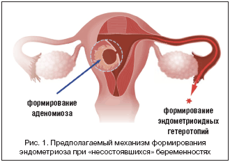 Рис. 1. Предполагаемый механизм формирования эндометриоза при «несостоявшихся» беременностях