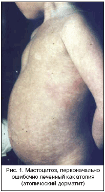 Рис. 1. Мастоцитоз, первоначально ошибочно леченный как атопия (атопический дерматит)