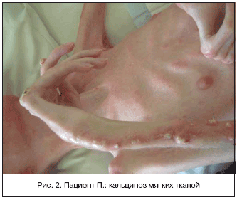 Рис. 2. Пациент П.: кальциноз мягких тканей
