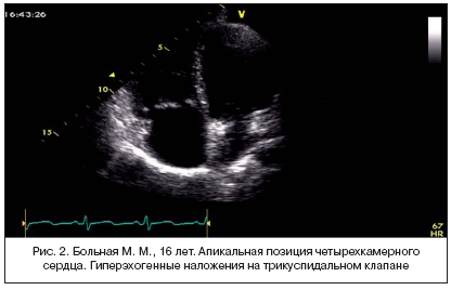 Рис. 2. Больная М. М., 16 лет. Апикальная позиция четырехкамерного сердца. Гиперэхогенные наложения на трикуспидальном клапане
