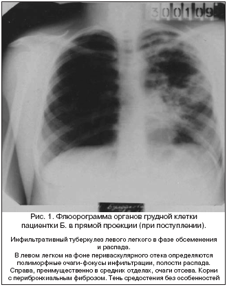 Рис. 1. Флюорограмма органов грудной клетки пациентки Б. в прямой проекции (при поступлении).