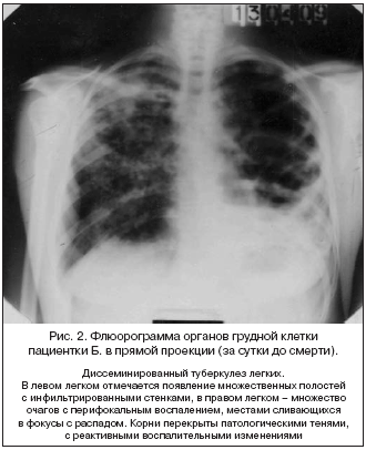 Рис. 2. Флюорограмма органов грудной клетки пациентки Б. в прямой проекции (за сутки до смерти).