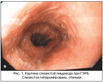 Рис. 1. Картина слизистой пищевода при ГЭРБ. Слизистая гиперемирована, отечная