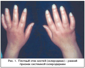 Рис. 1. Плотный отек кистей (склеродема) – ранний признак системной склеродермии