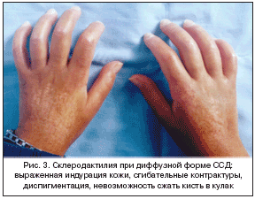 Рис. 3. Склеродактилия при диффузной форме ССД: выраженная индурация кожи, сгибательные контрактуры, диспигментация, невозможность сжать кисть в кулак