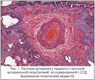 Рис. 1. Легочная артериола у пациента с легочной артериальной гипертензией, ассоциированной с ССД. Выраженная гипертрофия медии [5]