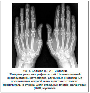 Стадии рентгенологических изменений в суставах при ревматоидном артрите