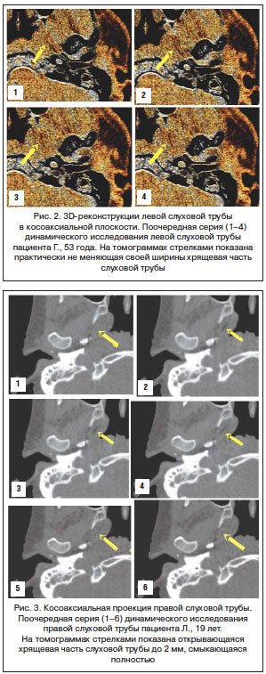 Функциональная мультиспиральная компьютерная томография в диагностике дисфункции слуховой трубы при патологии носоглотки