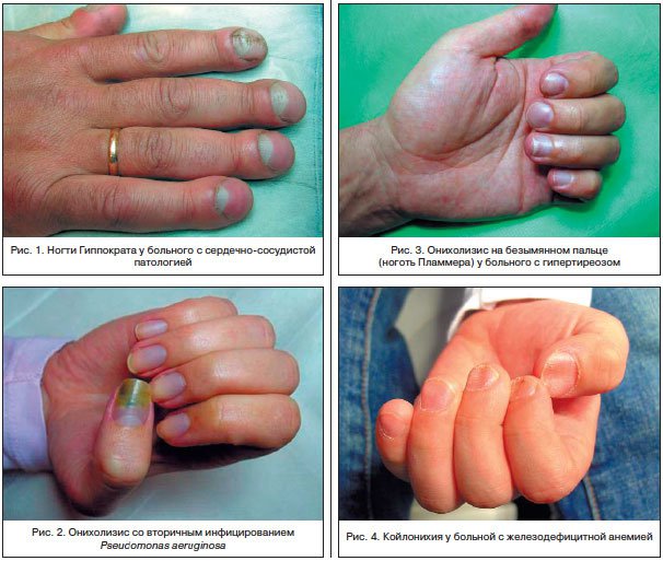 11 признаков на ногтях, что нужно немедленно обратиться к врачу