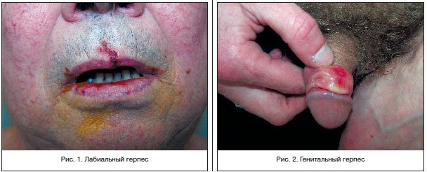 Герпес на губах: лечение диодным лазером (взрослым и детям)