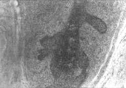 Рис. 6. Вилочковая железа. В дольках отсутствует деление на корковый и мозговой слои. Разрастание междольковой соединительной ткани с диффузными плазматическими инфильтратами. 