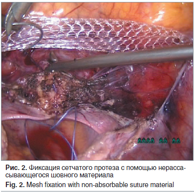 Рис. 2. Фиксация сетчатого протеза с помощью нерасса- сывающегося шовного материала Fig. 2. Mesh fixation with non-absorbable suture material
