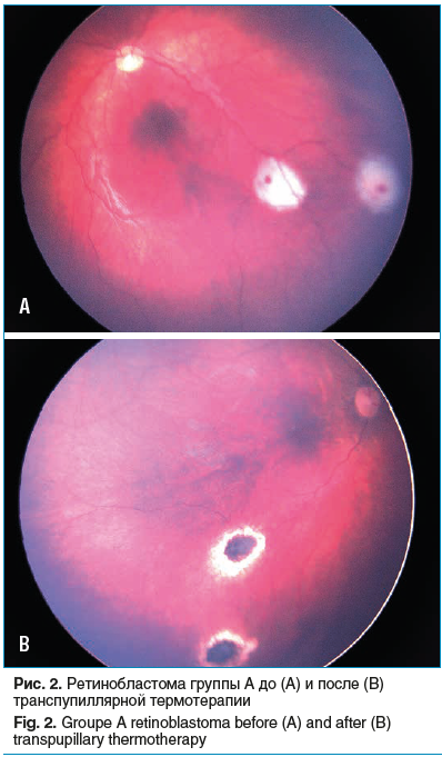 Рис. 2. Ретинобластома группы А до (A) и после (B) транспупиллярной термотерапии Fig. 2. Groupe A retinoblastoma before (A) and after (B) transpupillary thermotherapy