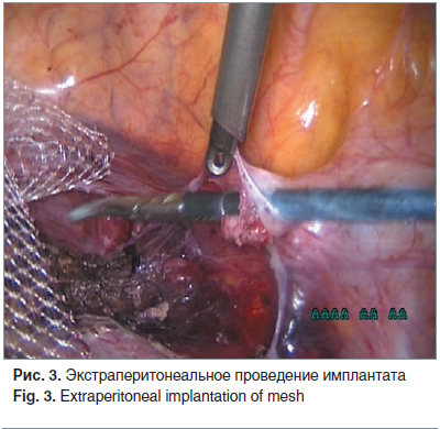 Рис. 3. Экстраперитонеальное проведение имплантата Fig. 3. Extraperitoneal implantation of mesh