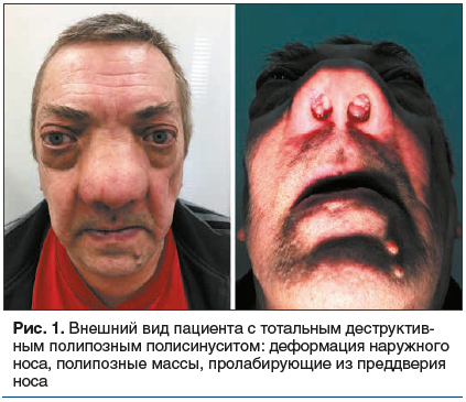 Рис. 1. Внешний вид пациента с тотальным деструктив- ным полипозным полисинуситом: деформация наружного носа, полипозные массы, пролабирующие из преддверия носа