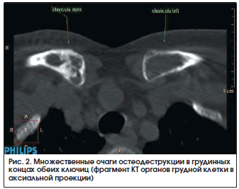 Рис. 2. Множественные очаги остеодеструкции в грудинных концах обеих ключиц (фрагмент КТ органов грудной клетки в аксиальной проекции)